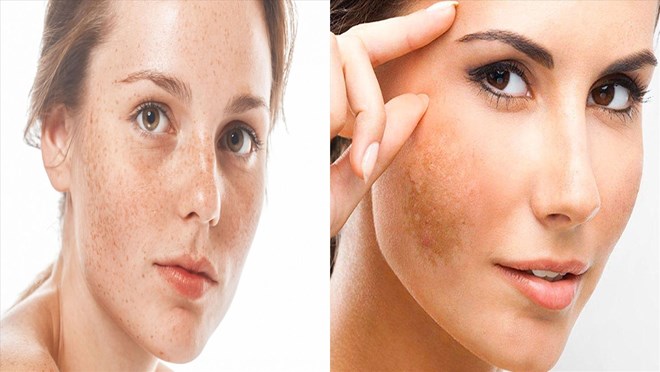 Nguyên nhân gây tăng sắc tố ở phụ nữ sau sinh