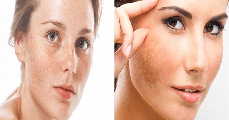 Nguyên nhân gây tăng sắc tố ở phụ nữ sau sinh