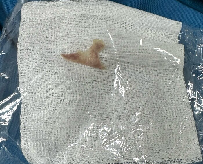 Mảnh xương gắp từ thực quản bệnh nhân C ở Quảng Ngãi. Ảnh: Kim Ny