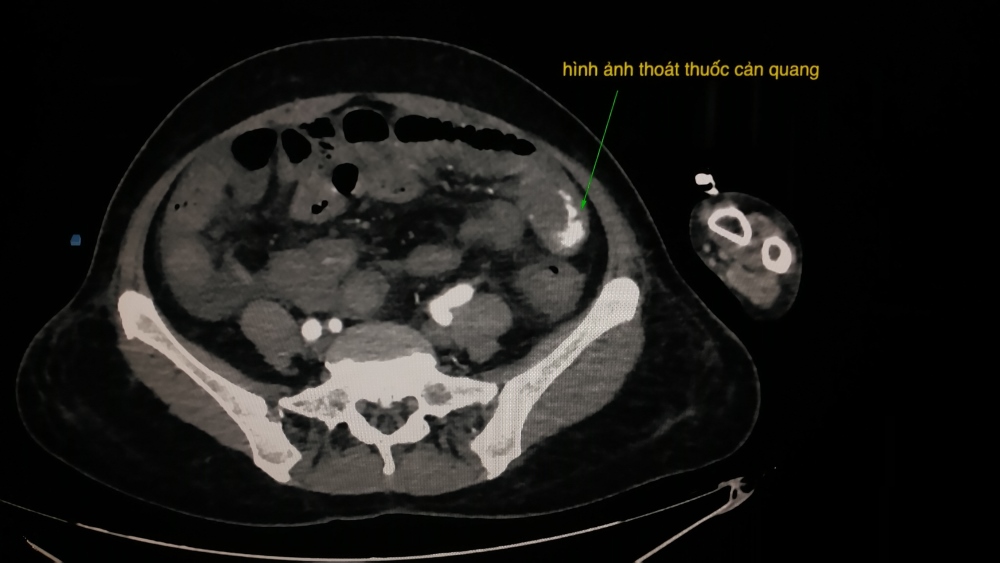 Hình ảnh chụp cắt lớp vi tính bụng  có cản quang ghi nhận có hiện tượng thoát thuốc cản quang. Ảnh: BVCC. 