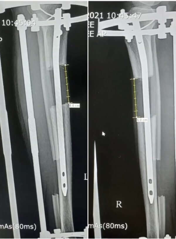 Chụp X-quang tình trạng chân của chị Ngọc Anh. Ảnh: NVCC.