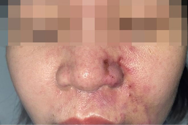 Biến chứng do tiêm filler tại cơ sở cắt tóc, gội đầu. Ảnh: Bệnh viện cung cấp