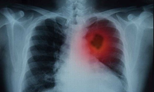 Ung thư phổi là căn bệnh khó phát hiện ở giai đoạn sớm. Ảnh: Lungcancers.eu