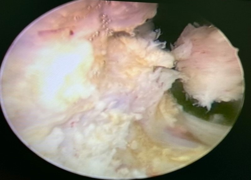 Phẫu thuật nội soi qua niệu đạo cắt đốt tiền liệt tuyến cho bệnh nhân bị u xơ nặng. Ảnh: Sông Hàn