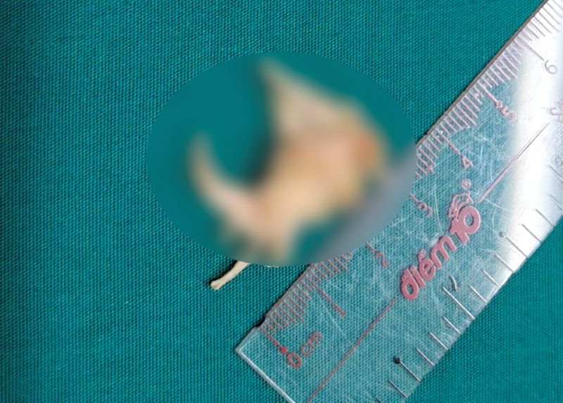 Gắp dị vật là miếng thịt gà kèm có xương nằm vắt ngang lòng thực quản. Ảnh: Bệnh viện cung cấp