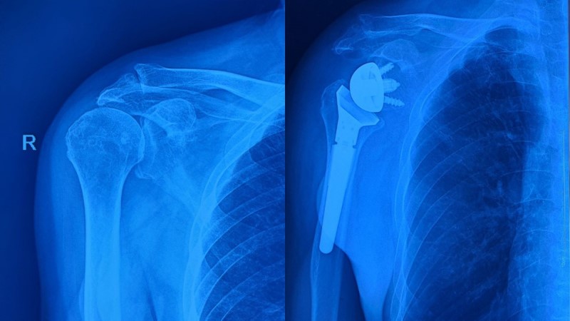 Right shoulder joint before and after surgery. Photo: Han River