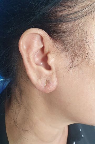 Infectious complications after ear filler injection. Photo: Provided by the hospital