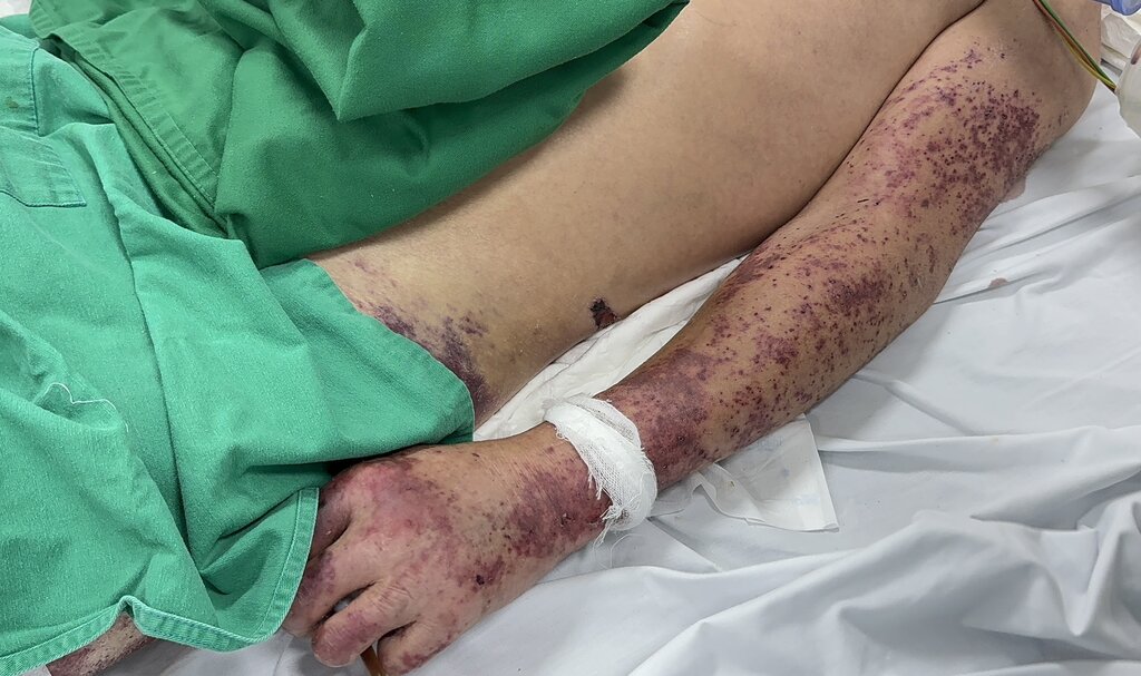 Người bệnh bị liên cầu lợn nhiễm khuẩn. Ảnh: BVCC