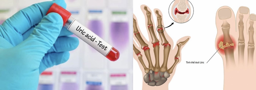 Xét nghiệm chỉ số axit uric giúp chẩn đoán bệnh gút. Đồ hoạ: Hương Giang 
