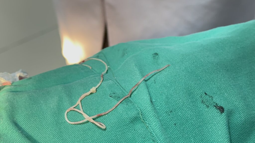 Giun sán ký sinh trùng được lấy ra từ cơ thể người bệnh. Ảnh: BVCC