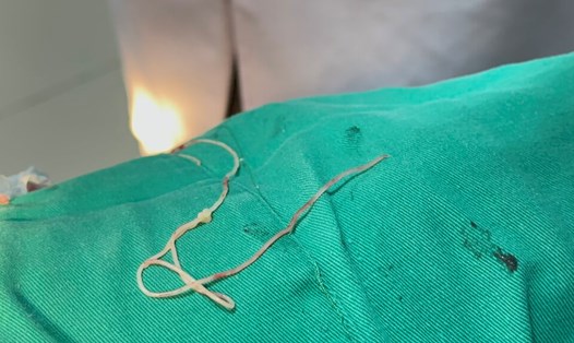 Giun sán ký sinh trùng được lấy ra từ cơ thể người bệnh. Ảnh: BVCC