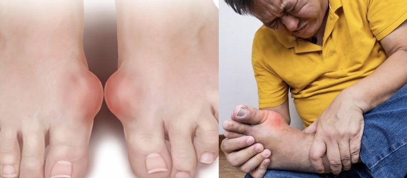 Nam giới thường mắc bệnh gút, thừa axit uric nhiều hơn nữ giới. Đồ hoạ: Hương Giang 