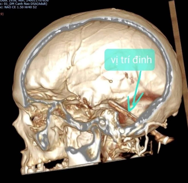 Phẫu thuật lấy đinh thép 7cm nằm trong não gần một năm