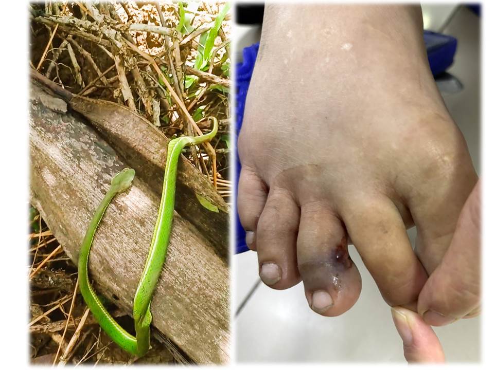 Hình ảnh rắn lục đuôi đỏ tấn công nạn nhân. Ảnh: BVCC