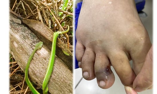 Hình ảnh rắn lục đuôi đỏ tấn công nạn nhân. Ảnh: BVCC