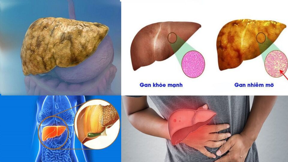 Treatment for fatty liver focuses on healthy eating, an active lifestyle, and weight loss. Graphics: Quynh Anh