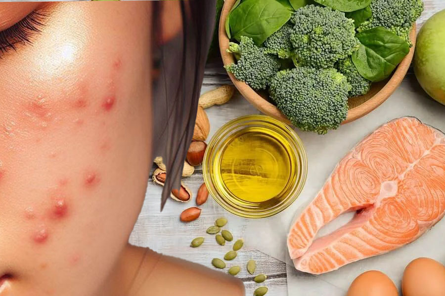 Lợi ích của axit béo omega-3 giúp giảm mụn trứng cá. Đồ hoạ: Thiện Nhân