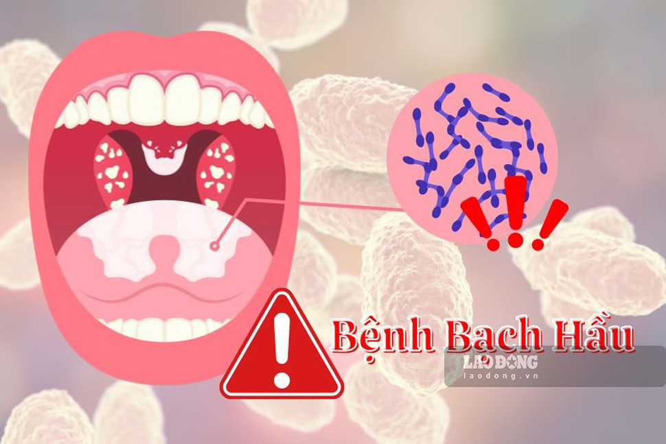 Chủ tịch tỉnh Bình Định yêu cầu các cơ quan, đơn vị, địa phương cùng vào cuộc phòng, chống bệnh bạch hầu. Đồ họa: Hoài Luân