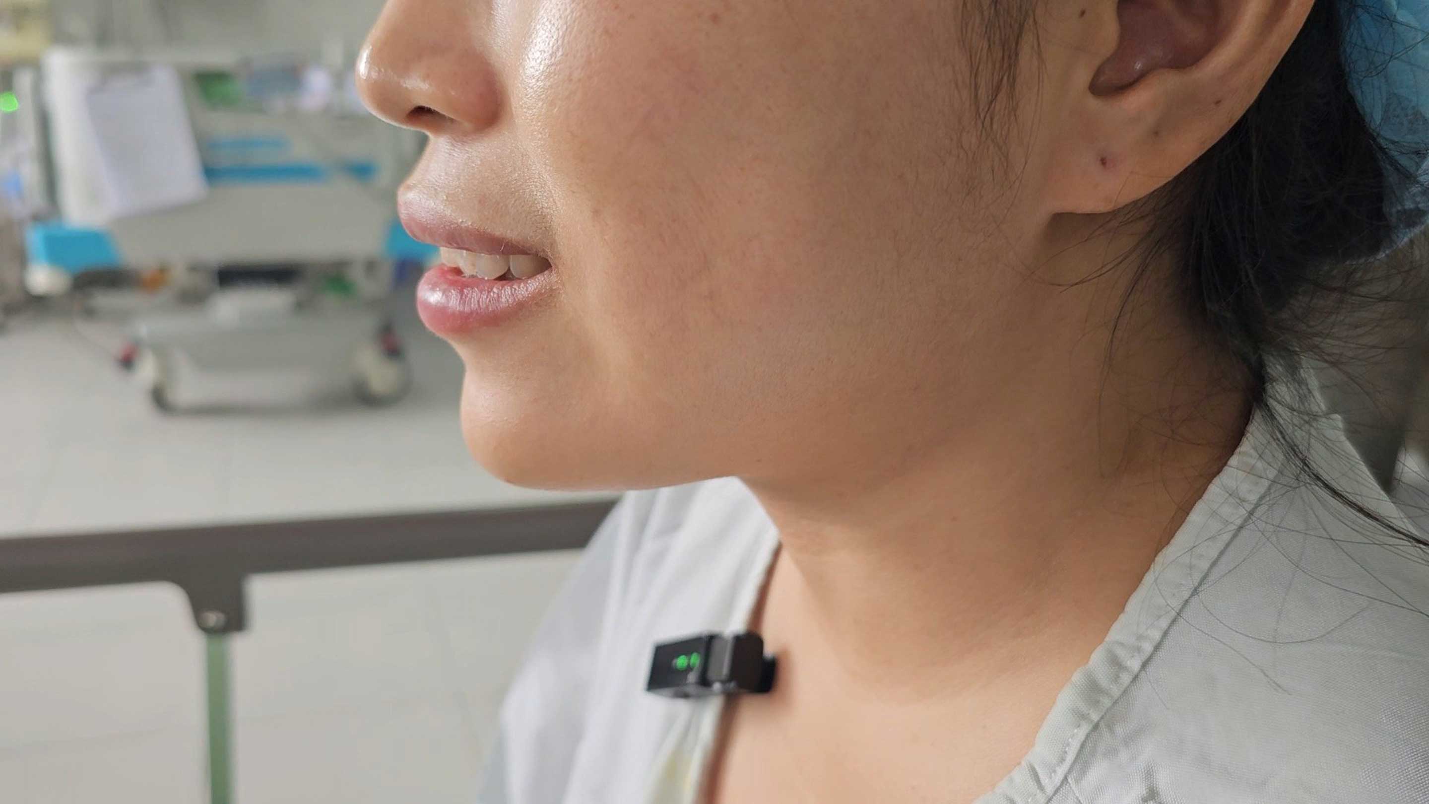 Vùng má của bệnh nhân trở về bình thường sau khi thực hiện thủ thuật. Ảnh: Bệnh viện cung cấp