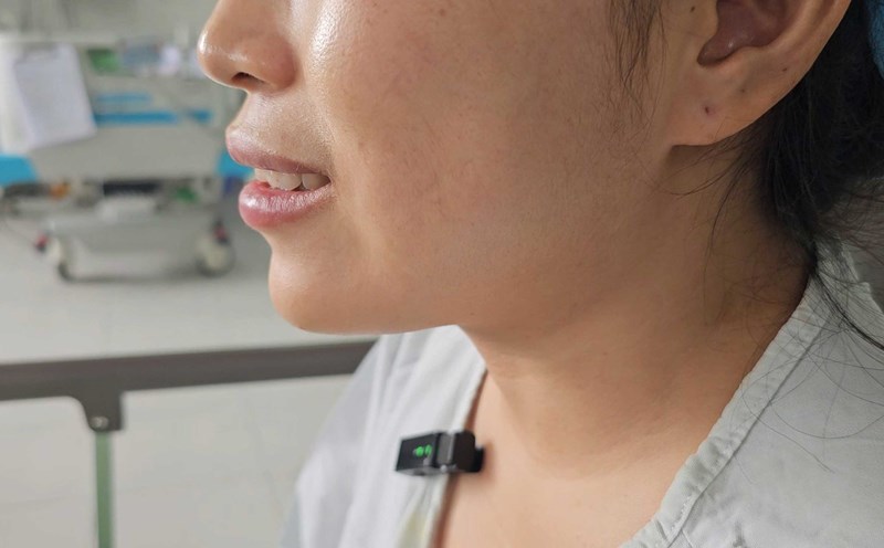 Vùng má của bệnh nhân trở về bình thường sau khi thực hiện thủ thuật. Ảnh: Bệnh viện cung cấp