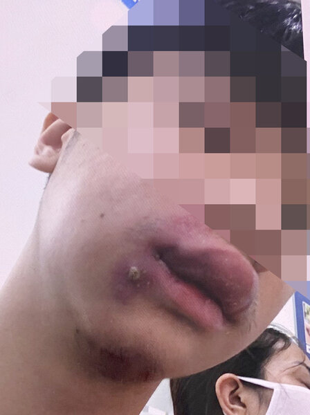 환자의 입술과 왼쪽 뺨 부위 손상으로 인한 패혈증 사진. 사진: BVCC