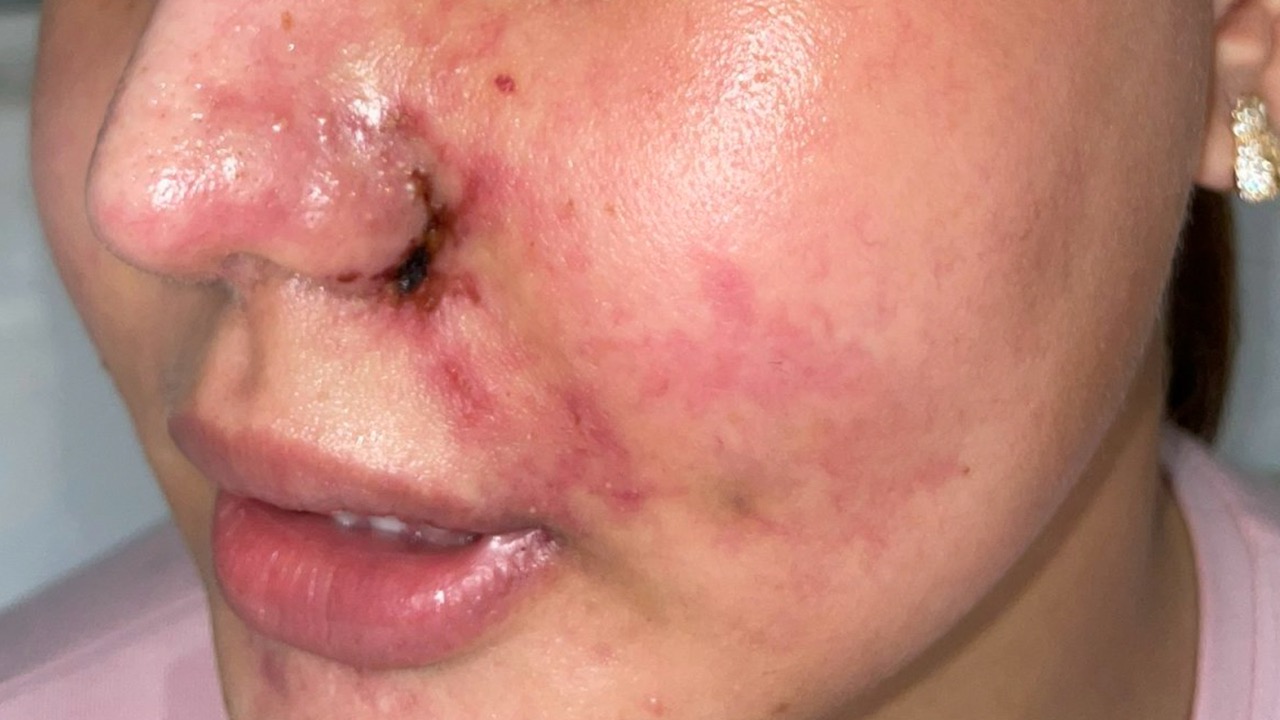 Bệnh nhân bị biến chứng tiêm filler mũi và má. Ảnh: NGUYỄN LY