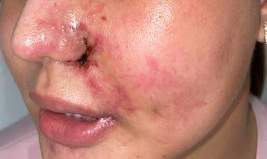Bệnh nhân bị biến chứng tiêm filler mũi và má. Ảnh: NGUYỄN LY