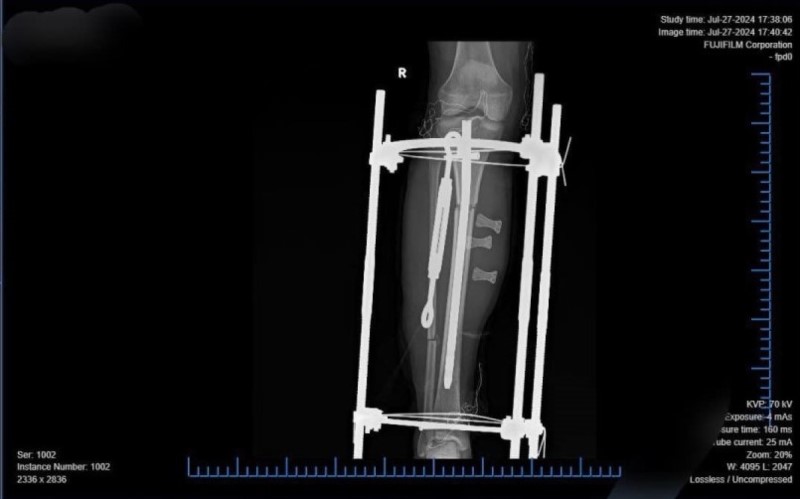 Kỹ thuật kéo dài chi