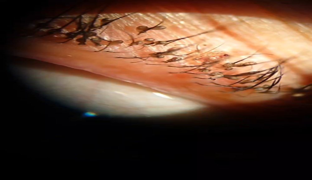 Dưới lớp kính hiển vi, các bác sĩ phát hiện mí mắt bệnh nhân có nhiều rận mu ký sinh. Ảnh: BVCC