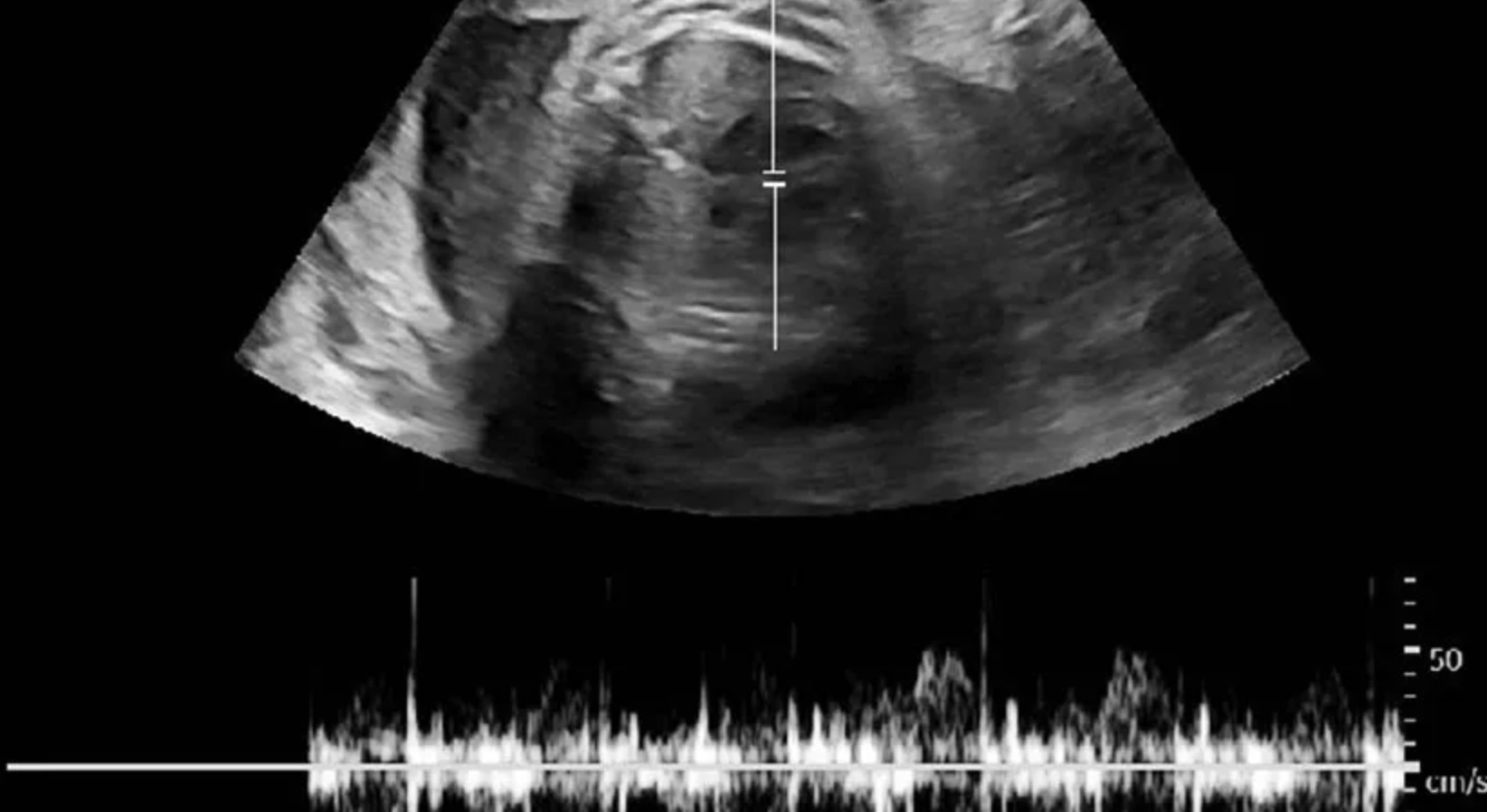 Sản phụ phát hiện khi đang mang thai ở tuần thứ 34. Ảnh: PHONG LAN