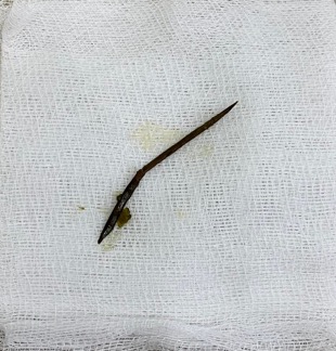 Dị vật gây thủng ruột non của người bệnh được lấy ra. Ảnh: BVCC