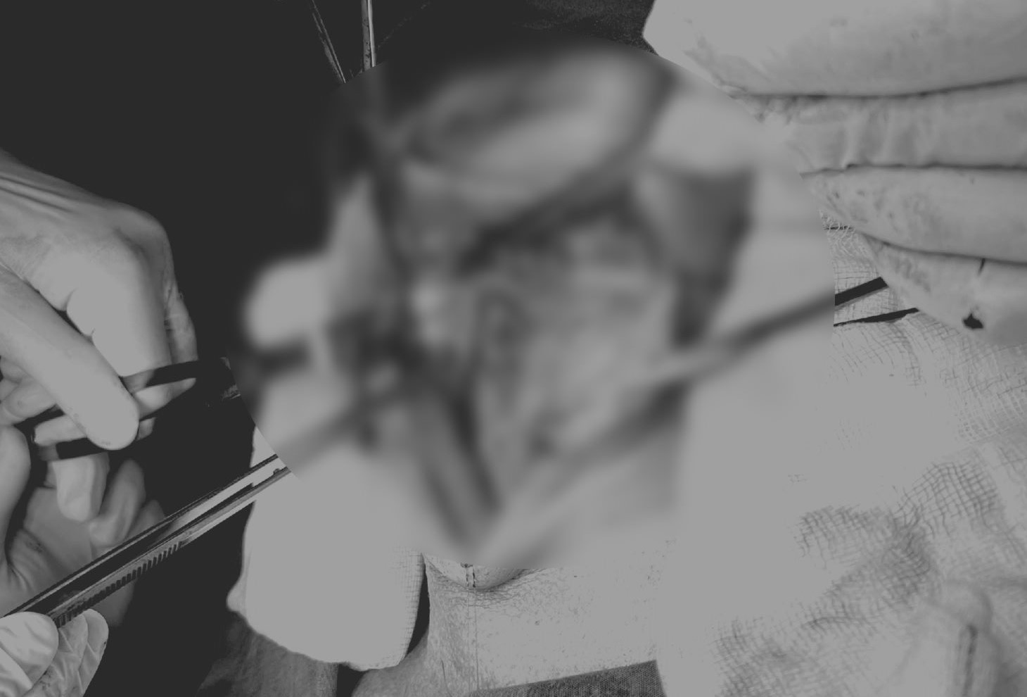 Ekip bác sĩ thực hiện phẫu thuật cắt bán phần lưỡi và nạo vét hạch. Ảnh: Bệnh viện cung cấp