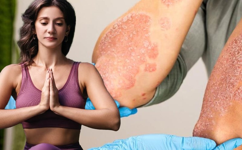 Các bài tập giúp kiểm soát bệnh viêm khớp vảy nến. Đồ hoạ: Thiện Nhân