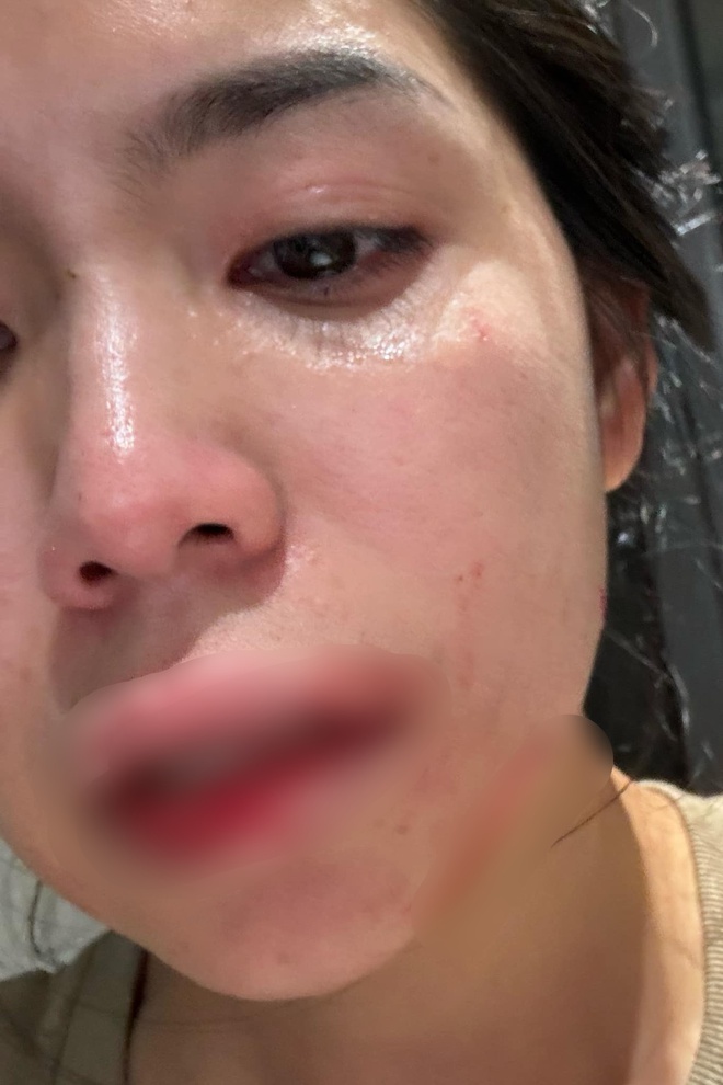 “Sister-in-law” Quang Linh Vlogs was physically abused by her husband. Photo: Facebook character.  