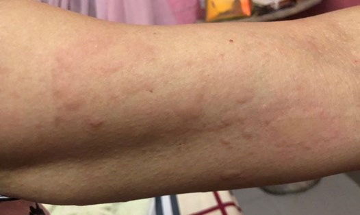 Nốt phát ban mày đay nổi khắp toàn thân bệnh nhân bị nhiễm giun chó mèo vì thói quen ăn thịt chua. Ảnh: BVCC