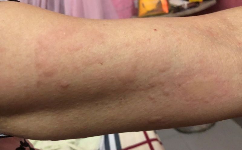 Nốt phát ban mày đay nổi khắp toàn thân bệnh nhân bị nhiễm giun chó mèo vì thói quen ăn thịt chua. Ảnh: BVCC