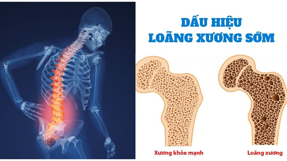 5 dấu hiệu cảnh báo sớm của bệnh loãng xương. Đồ họa: Cao Thơm 