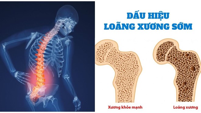 5 dấu hiệu cảnh báo sớm của bệnh loãng xương