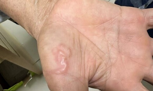 Hình ảnh giun đũa trong cơ thể. Ảnh: BVCC