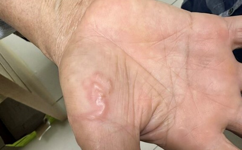 Hình ảnh giun đũa trong cơ thể. Ảnh: BVCC