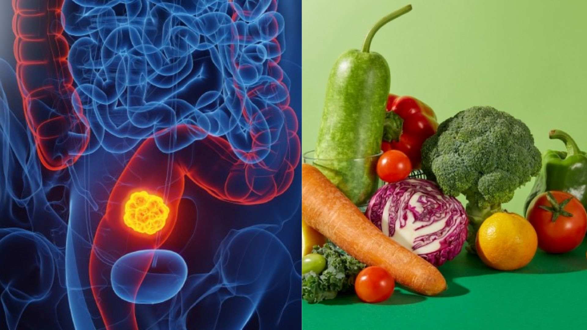 Phòng ngừa bệnh ung thư trực tràng. Ảnh: Bệnh viện