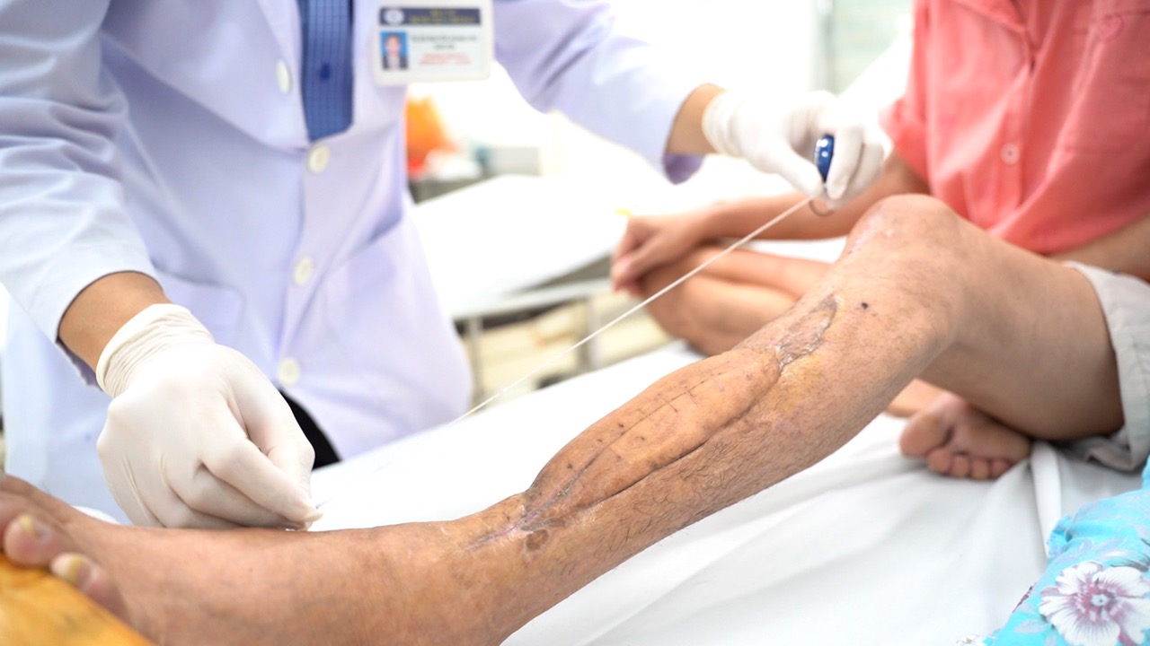 Bệnh nhân được ghép titan thành công. Ảnh: NGUYỄN LY