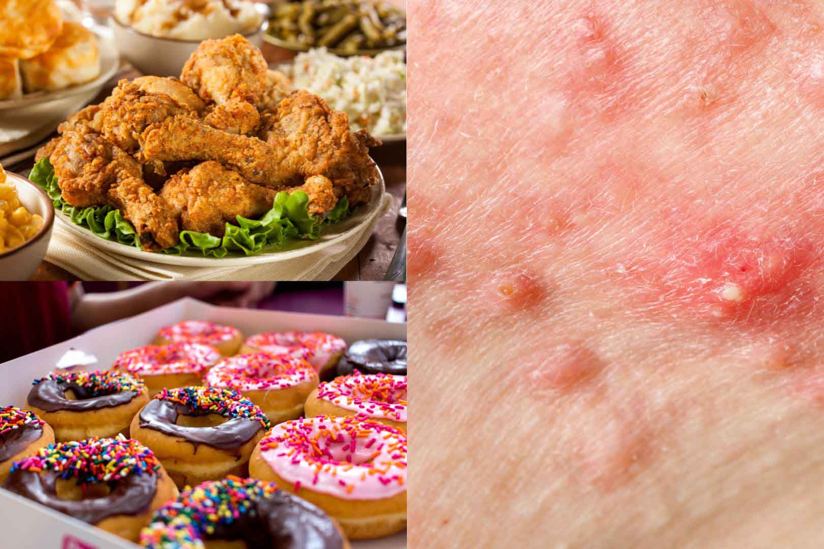 Tránh xa thực phẩm này nếu không muốn mụn nội tiết nặng hơn