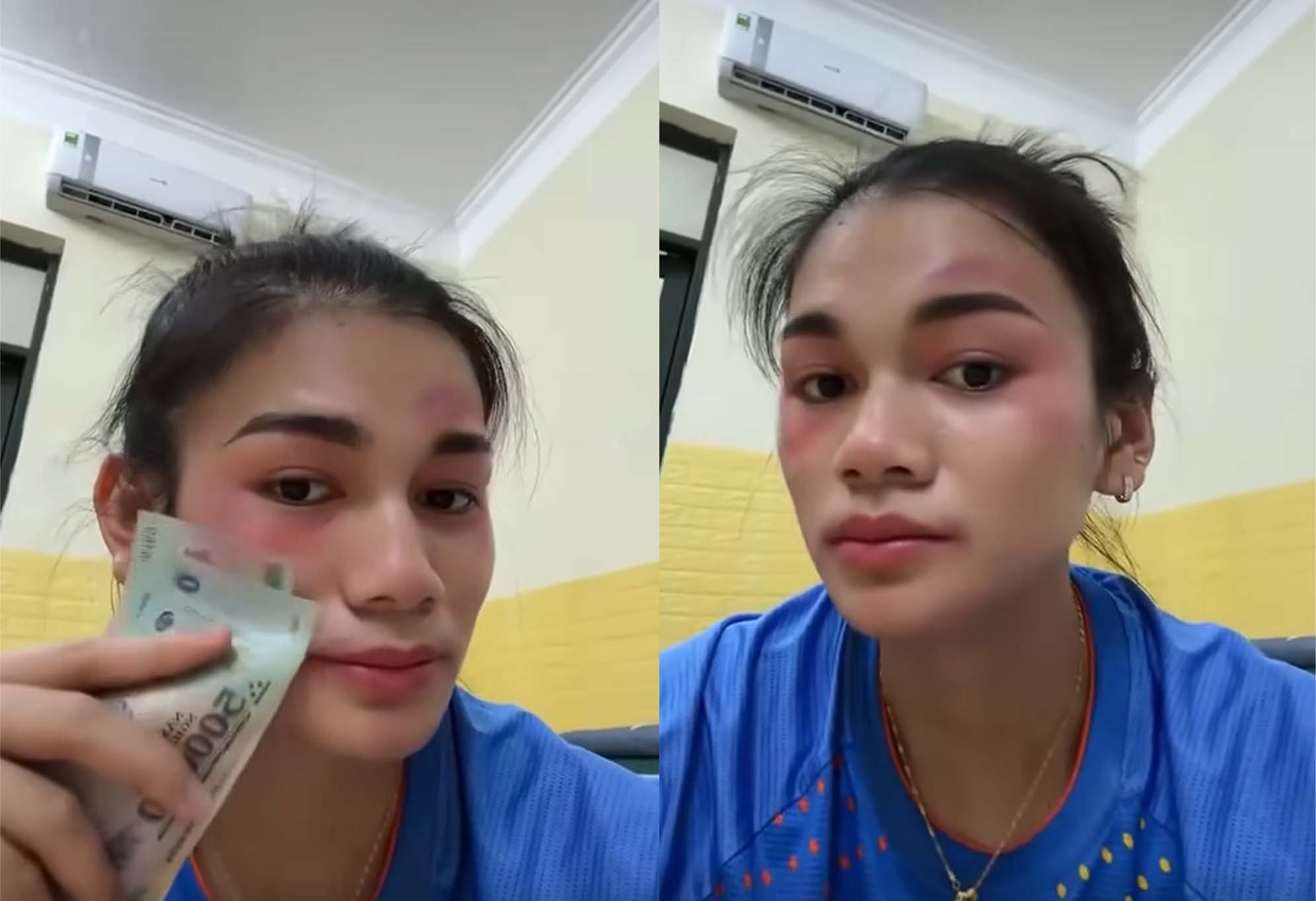 Nhu Quynh recorded a tiktok video using the injured face effect. Photo cut from video