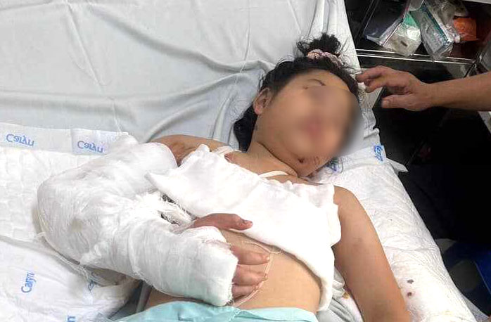 A serious traffic accident puts a 9-year-old girl at risk of having her arm amputated. Photo: An Nhien