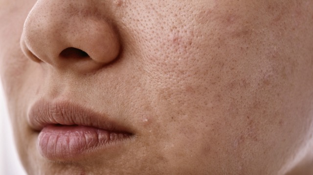 Kích ứng da mặt vì dưỡng da bằng rau củ tươi. Ảnh: BNCC