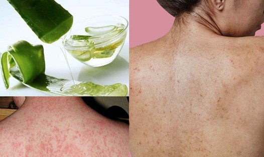Lô hội phương thuốc tự nhiên chữa lành bệnh phát ban trên da. Đồ họa: Cao Thơm