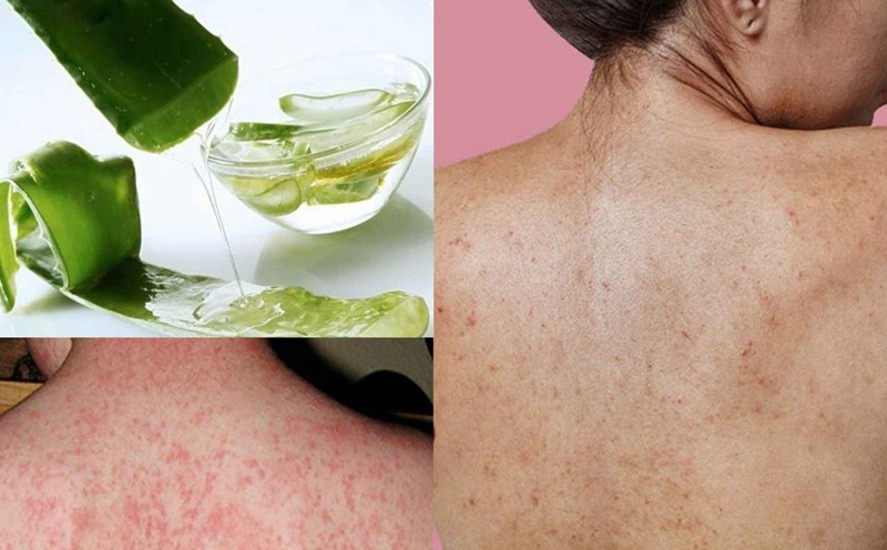 Lô hội phương thuốc tự nhiên chữa lành bệnh phát ban trên da. Đồ họa: Cao Thơm