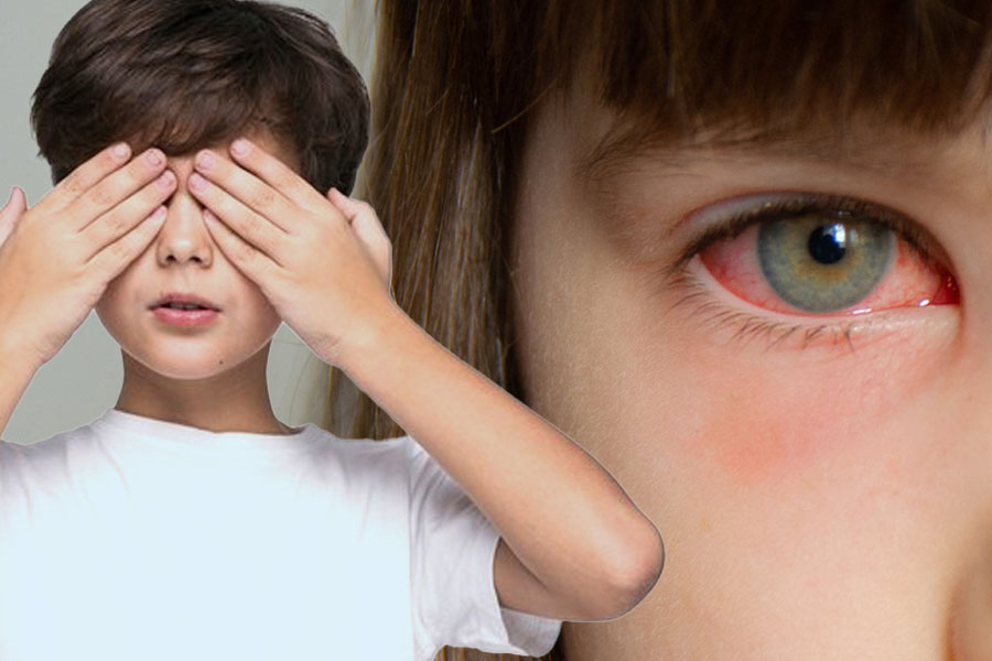 Trẻ em dễ bị viêm kết mạc hơn trong các đợt gió mùa. Đồ hoạ: Thiện Nhân