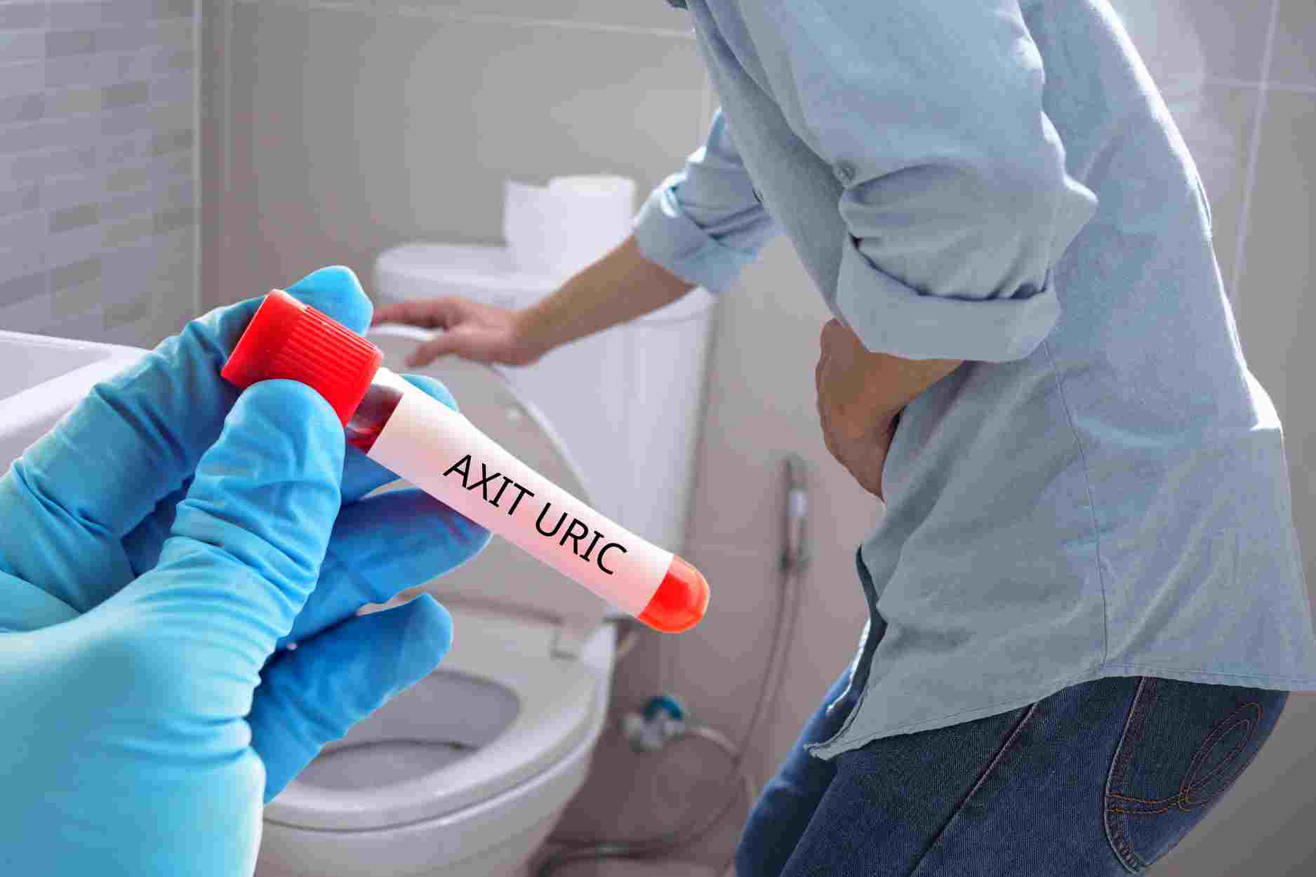 Dấu hiệu khi đi tiểu chứng tỏ axit uric tăng không kiểm soát